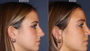 How Much Does a Nose Job Cost with Insurance